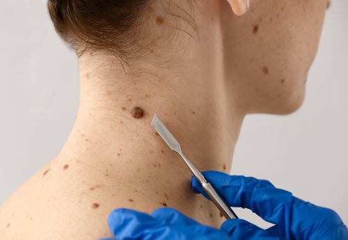 Dermatologist preparing to remove a mole to check for skin cancer